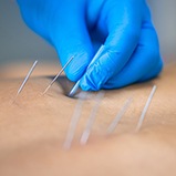 provider inserting needles for dry needling in a patient’s back