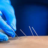 several dry needles in a patient’s back
