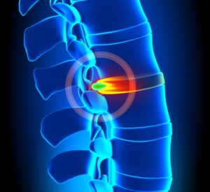 diagram of a herniated disc from whiplash